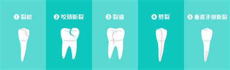 牙齒掉下來|牙齒斷掉：處理、預防與修復